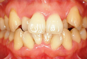 叢生（乱ぐい歯）