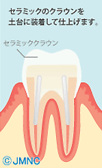 セラミックのクラウンを土台に装着して仕上げます。